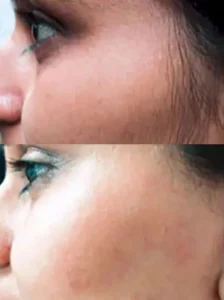 Lanveza™ IPL Laser Hair Removal Handset photo review