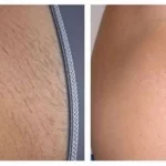 Lanveza™ IPL Laser Hair Removal Handset