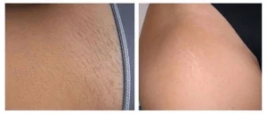 Lanveza™ IPL Laser Hair Removal Handset photo review