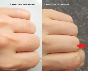 Lanveza™ IPL Laser Hair Removal Handset photo review