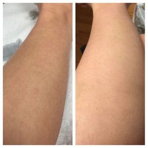 Lanveza™ IPL Laser Hair Removal Handset photo review